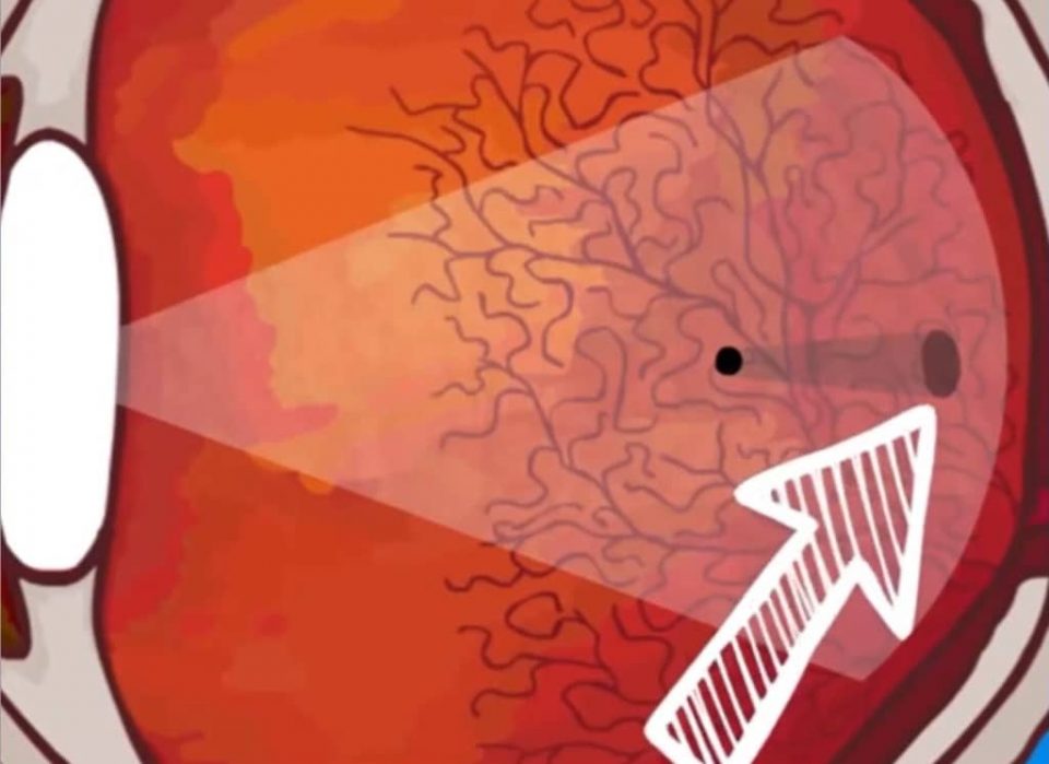 Syndrome de la mouche devant les yeux causes et traitements — free download