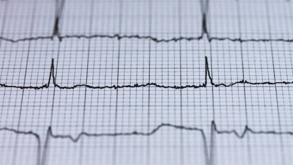 électrocardiogramme