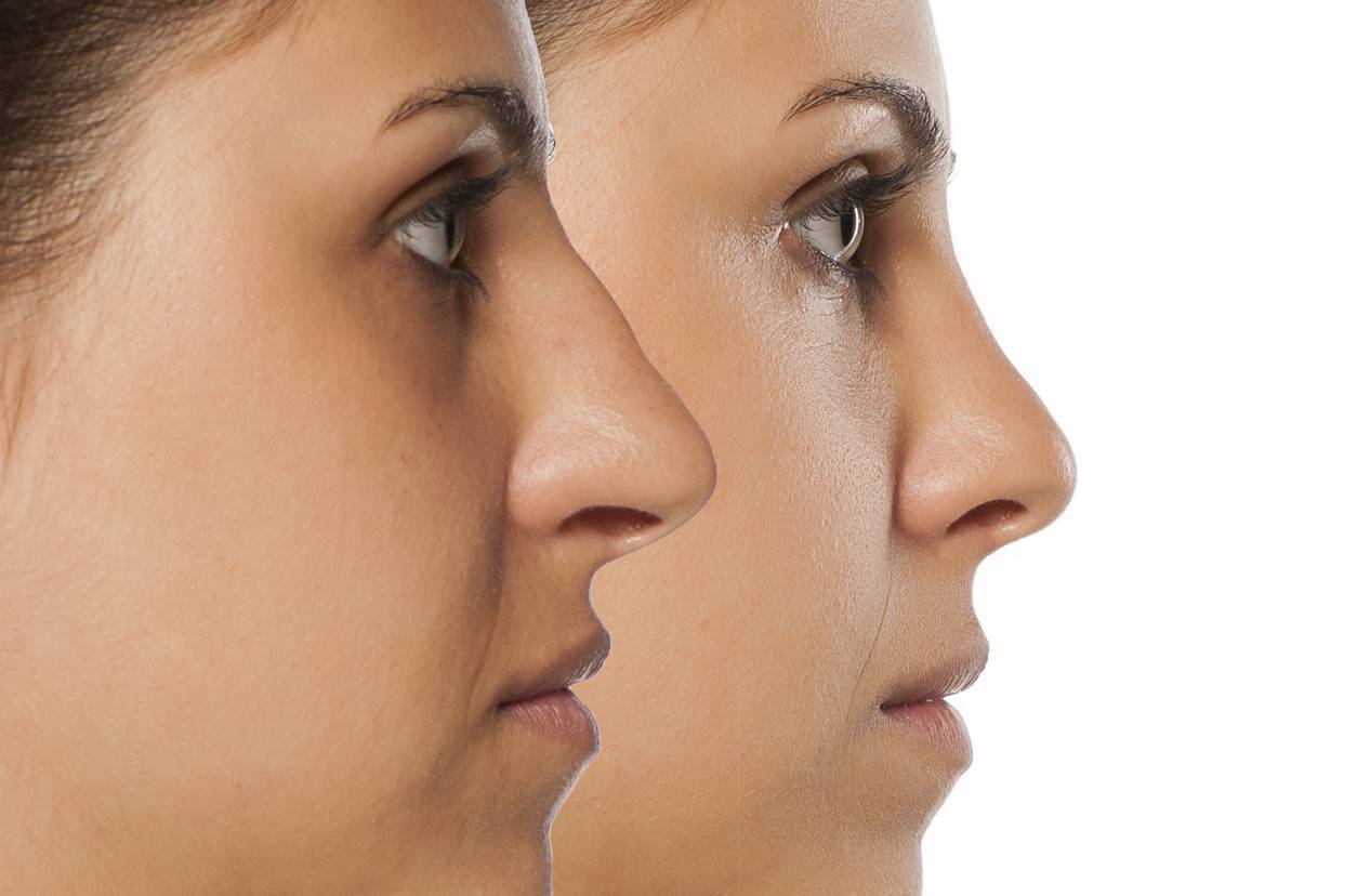 rhinoplastie