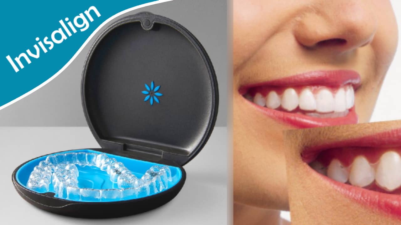 Aligneurs dentaires Invisalign : quels avantages