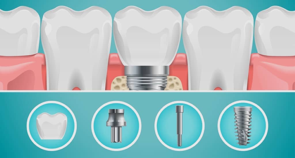 types d'implants dentaires