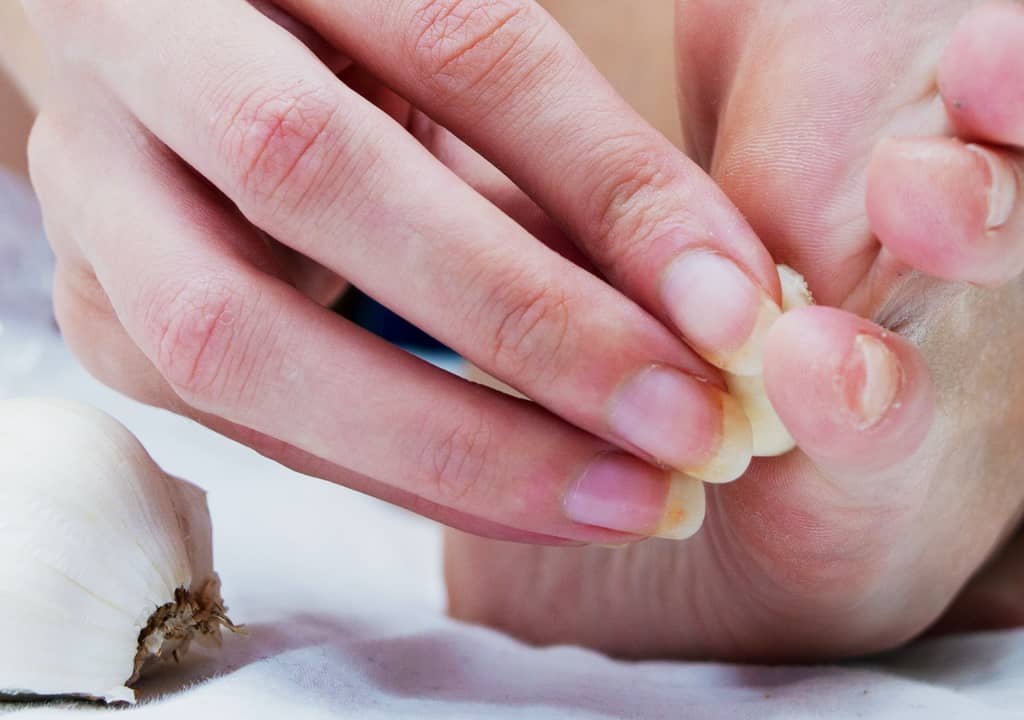 Comment traiter les cors aux pieds avec de l'ail ?