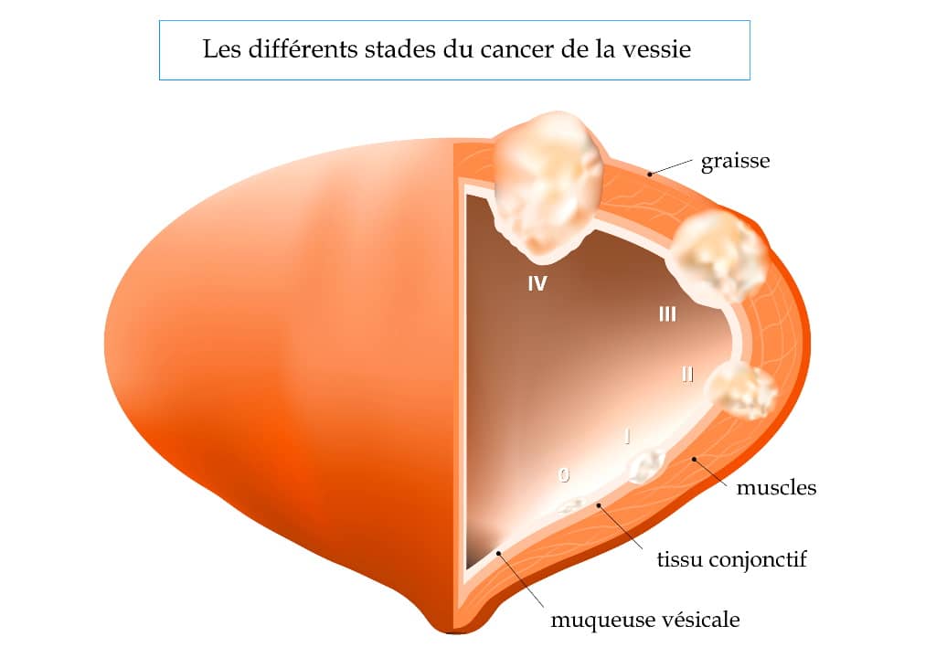 L'analyse d'urine permet-elle de détecter un cancer de la vessie ?