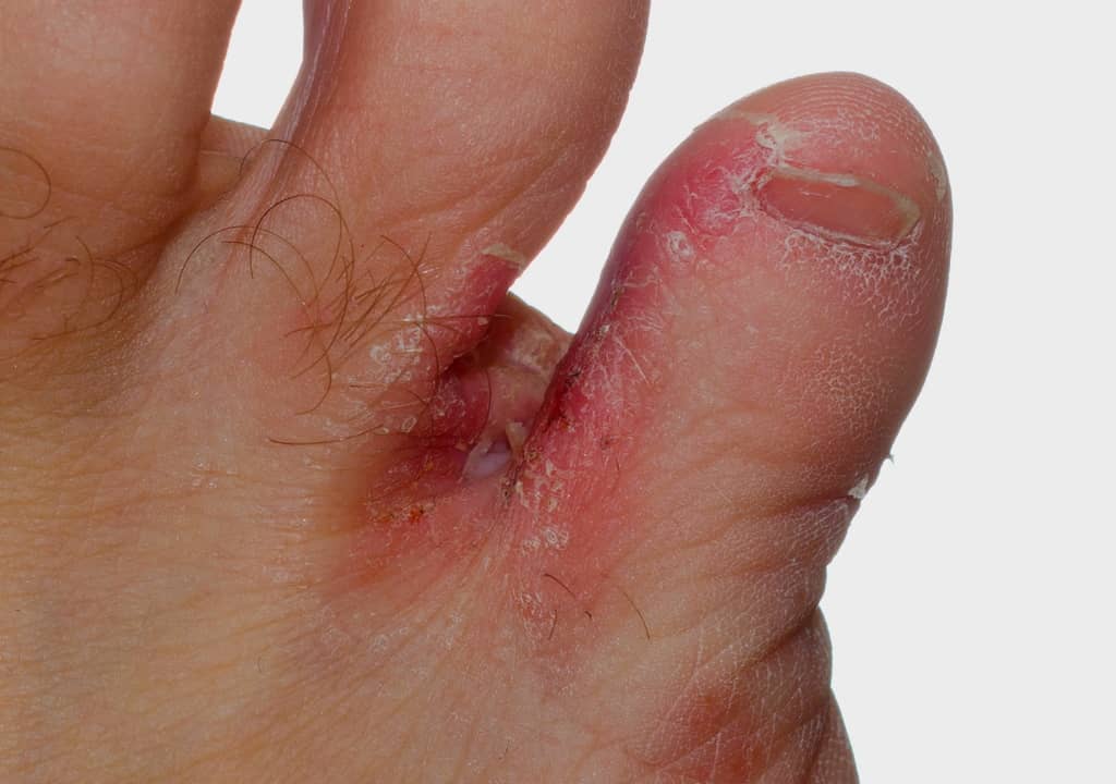 Quels sont les symptômes du syndrome des pieds brûlants ?