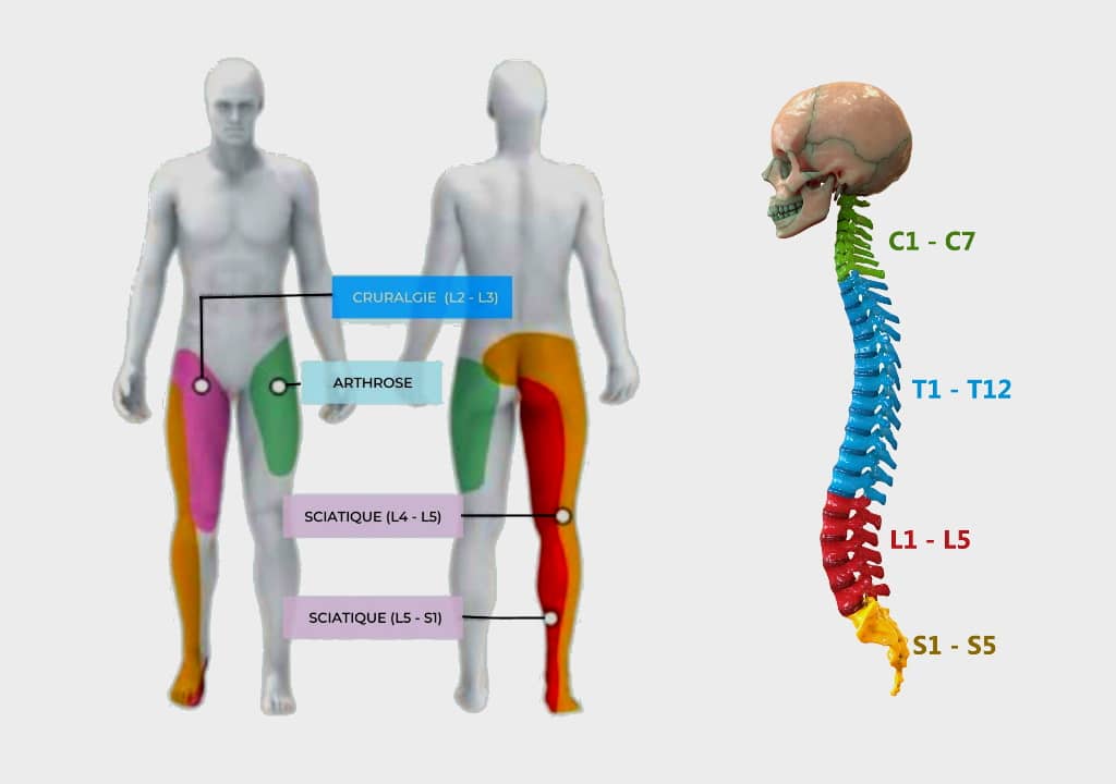 Comment faire la différence entre la sciatique et la cruralgie ?