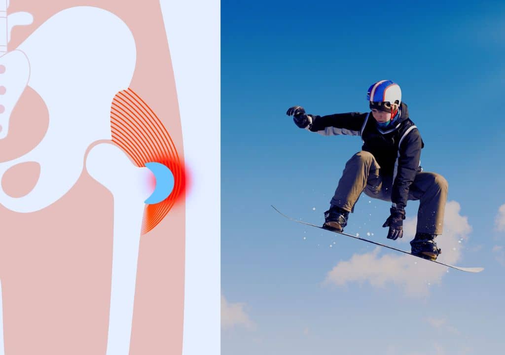 Quelles activités sportives favorisent l'apparition d'une bursite de la hanche ?