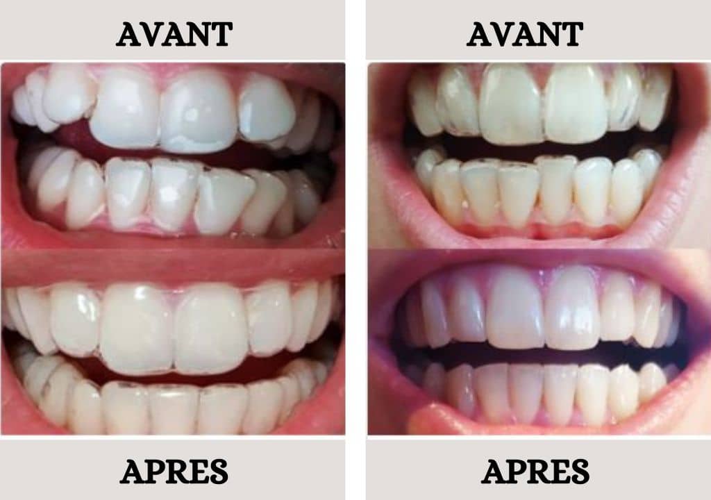 Quel est le résultat des mois de traitement orthodontique avec des aligneurs invisibles ?