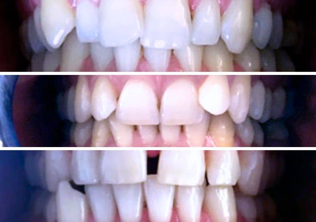 A quoi ressemblent des dents de travers ou tordues ?