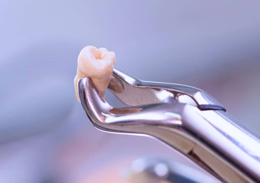 Un saignement bucco-dentaire provoque-t-elle un goût de fer dans la bouche ?