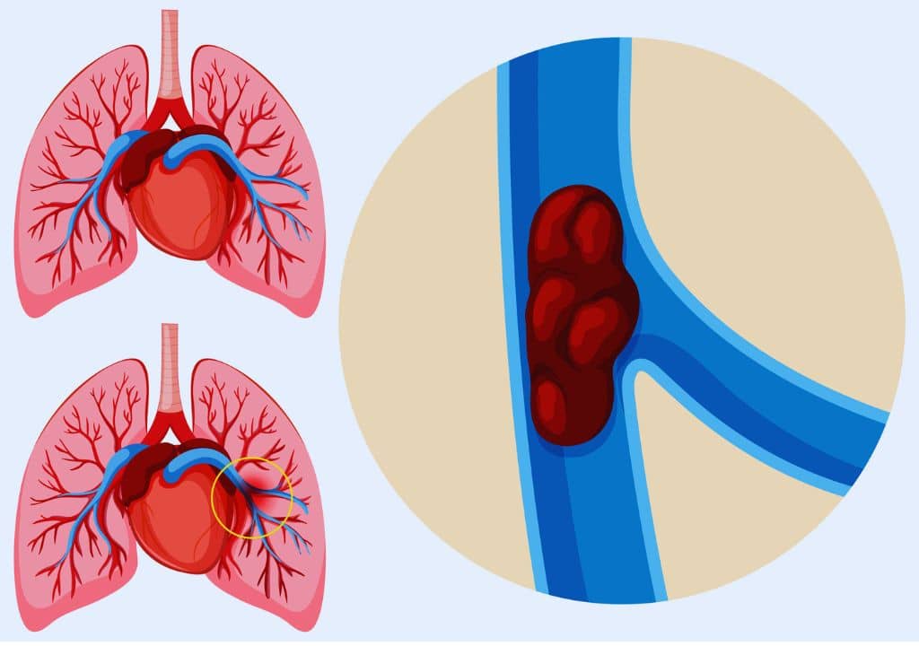 Pourquoi les femmes ayant des antécédents d'embolie pulmonaire ne peuvent pas subir une opération de raffermissement du vagin ?