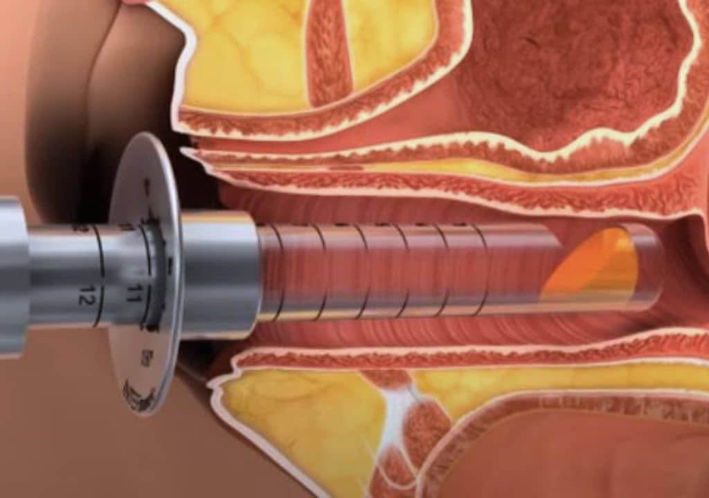 Comment traiter le relâchement des muscles du vagin et du périnée sans chirurgie invasive ?