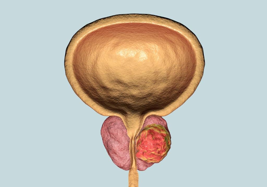 Comment se traduit le cancer de la prostate à un stade avancé ?