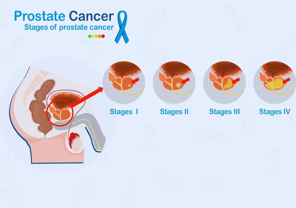 Quels sont les différents stades du cancer de la prostate chez les hommes ?