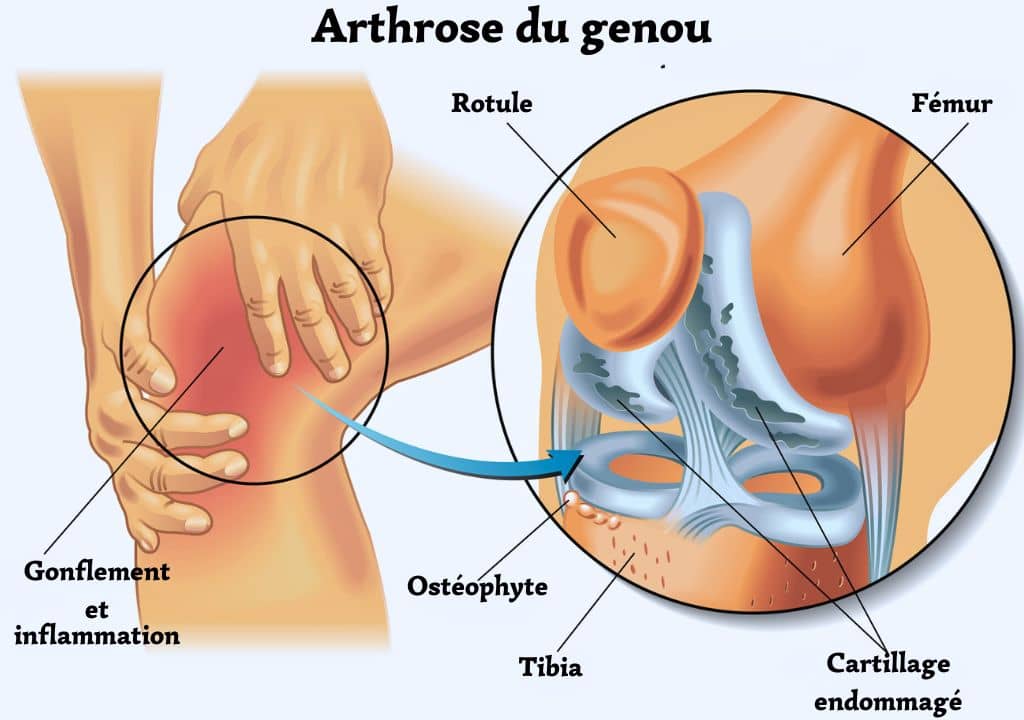 arthrose-genou-articulation