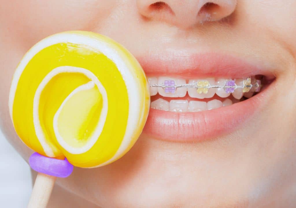 Quels aliments éviter pour la sécurité des dents après la pose d'un appareil dentaire ?
