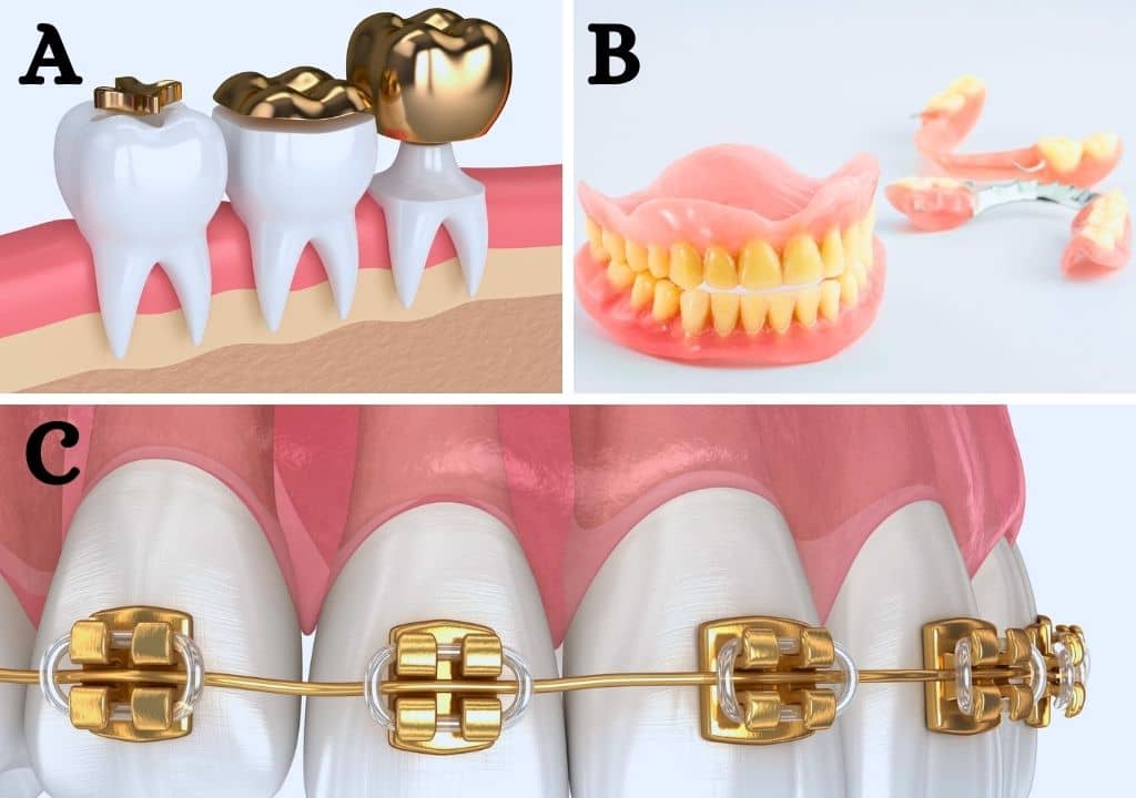 Quels sont les différents types de prothèses dentaires ?